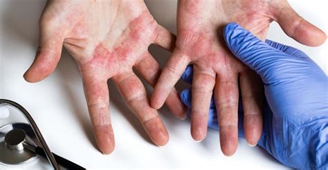 cum să tratezi ulcerul și dermatita cu varice
